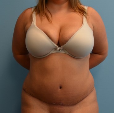 Tummy Tuck patient after 2