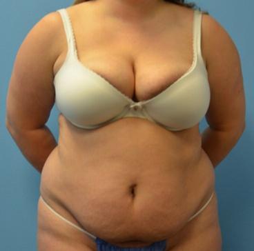 Tummy Tuck patient before 2