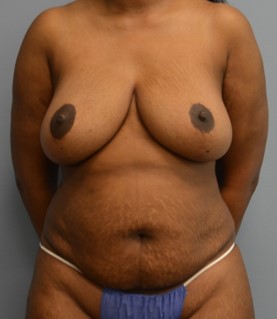 Tummy Tuck patient before