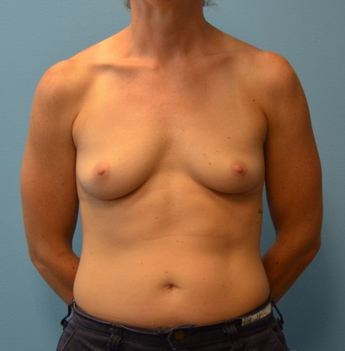 Breast Aug patient before 2