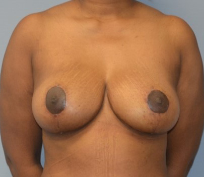 Breast Reduction patient after
