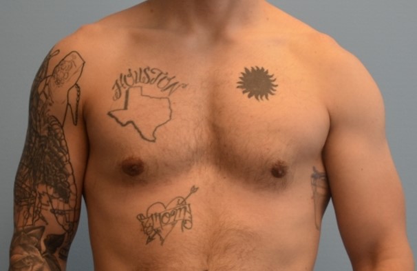 Case #3493 - Ellsworth Plastic Surgery